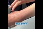 还没好又崴了！沈梓捷：和上次崴的同一只脚 没上次严重就是肿痛